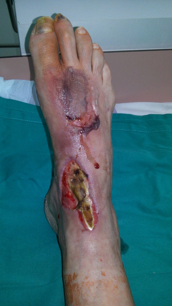 Kronična rana na goleni in stopalu zaradi prizadetih žil